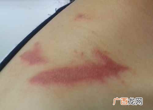 食物过敏有什么症状表现 食物过敏有什么症状
