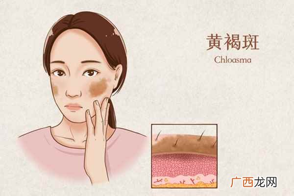 藏红花能去黄褐斑吗