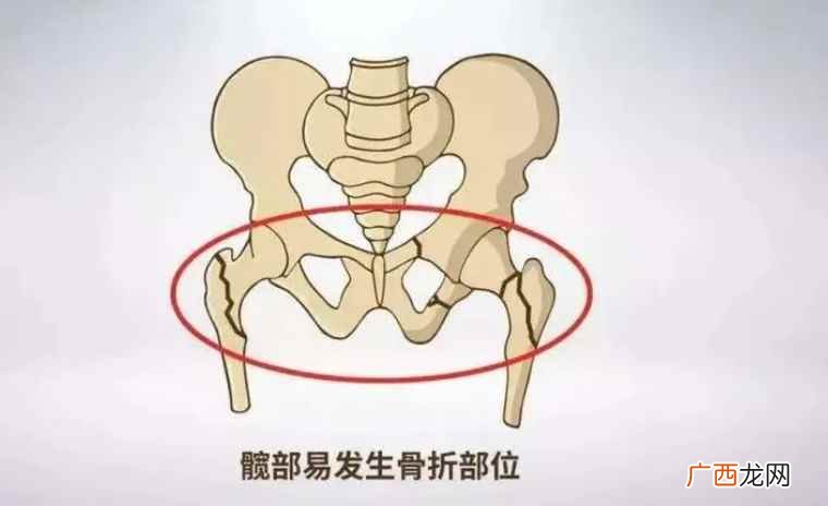 髋部是在大腿的最上端和骨盆相连的部位 髋部是哪里