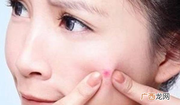 脸上长痘痘的原因以及如何预防和治疗 为什么脸上长痘痘