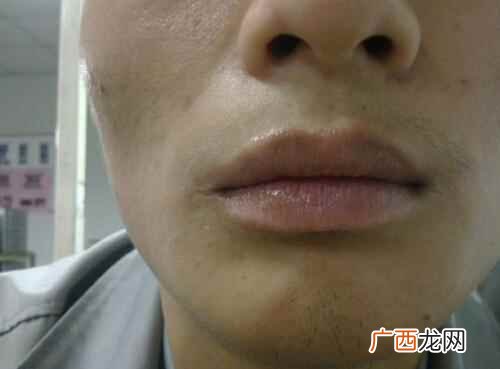 缺少维生素B2 嘴角开裂是什么原因,嘴角开裂是缺少什么