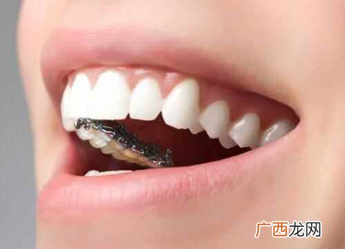 矫正牙齿会改变脸型吗成人 矫正牙齿会改变脸型吗