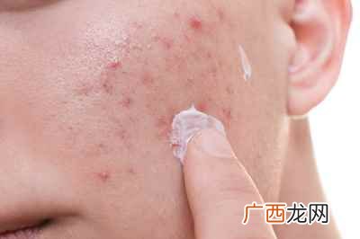 闭口是怎么形成的怎么去除 闭口是怎么形成的
