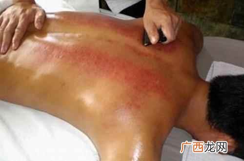 刮痧刮出来的痧是什么 刮痧刮出来的痧是什么,刮痧刮出来的痧图片