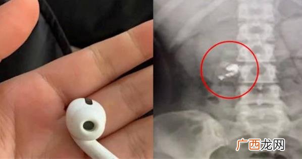 耳机误通过之后还能用吗 ?误吞耳机危害大吗