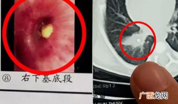 小孩气管堵塞的急救法叫什么 家长信偏方致3天大宝宝气管堵塞