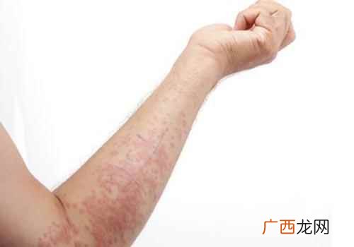起了湿疹可以吃蒜吗 得了湿疹能吃蒜吗