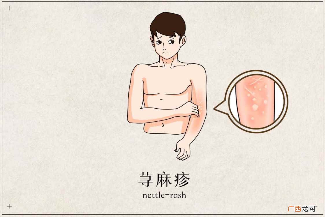 荨麻疹的常见原因及治疗方法 荨麻疹是什么原因引起的