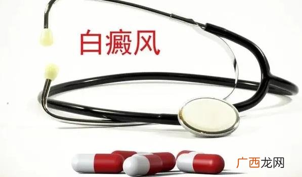 白癜风的病因是如何引起的 儿童白癜风一般是什么引起的