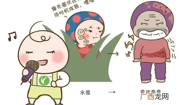 水痘 水痘、带状疱疹疫苗接种要点
