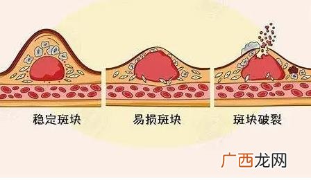 什么是血管的清道夫 血管清道夫清理血管的好方法