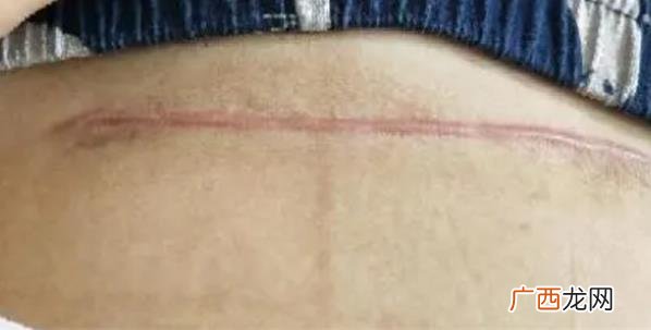 剖腹产能剖几次最合适 剖腹产能剖几次
