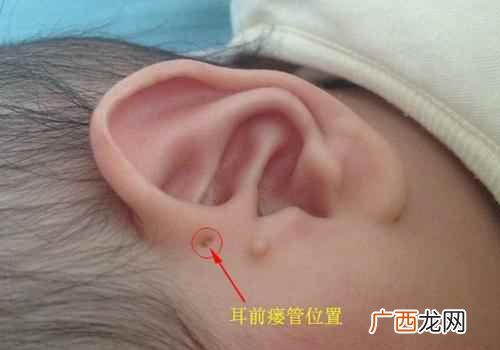 耳前瘘管什么原因导致的 耳前瘘管是怎么形成的
