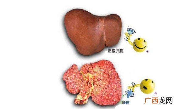 为什么肝癌通常一发现就是晚期了？