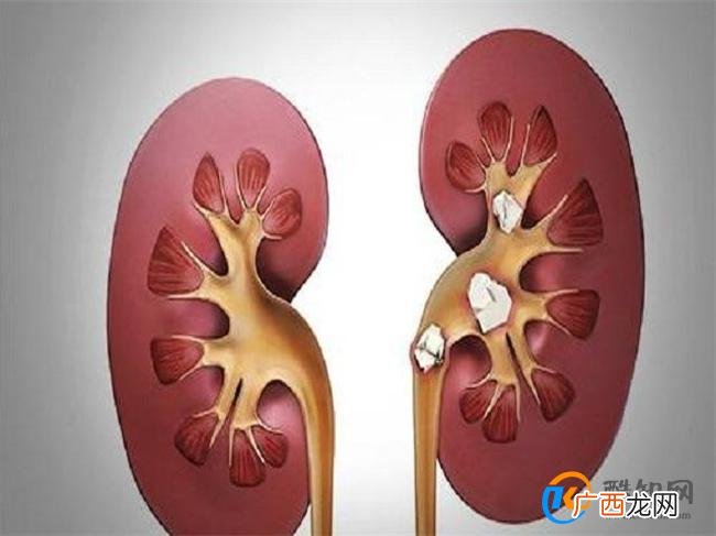 肾结石怎么引起的