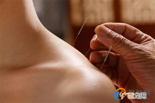 男子头疼自己在家针灸扎破心脏 如何正确针灸_酷知科普