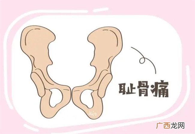 几类孕妇更容易患上“耻骨痛”，孕妈别大意，能避免就尽量避免