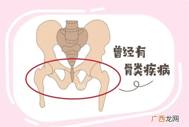 几类孕妇更容易患上“耻骨痛”，孕妈别大意，能避免就尽量避免