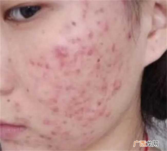 脸上长痘痘要怎么消除 脸上长痘痘如何消除