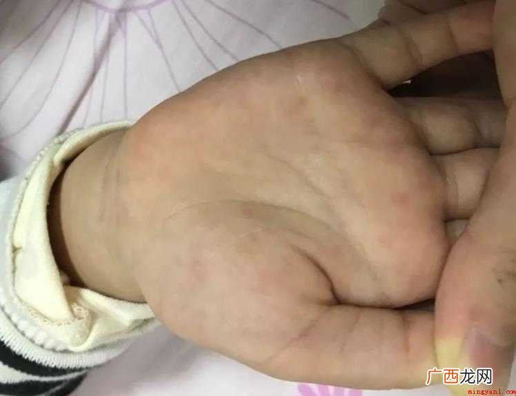 打了手足口疫苗出红疹怎么办