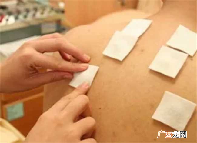 三伏贴一个疗程贴几次 三伏贴贴几次为一个疗程
