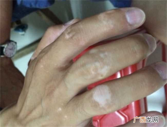突然长白斑怎么回事 突然长出白斑是什么原因