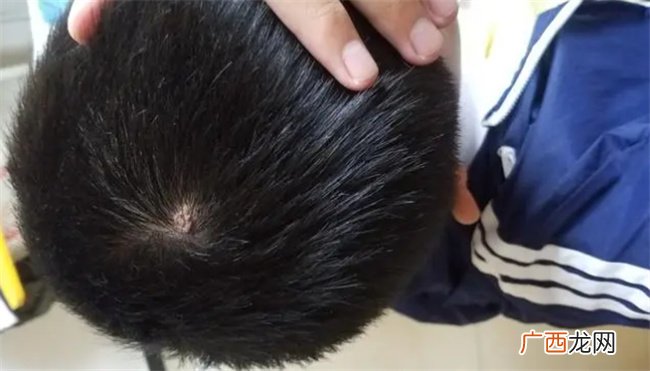 囊肿是什么 囊肿是什么引起