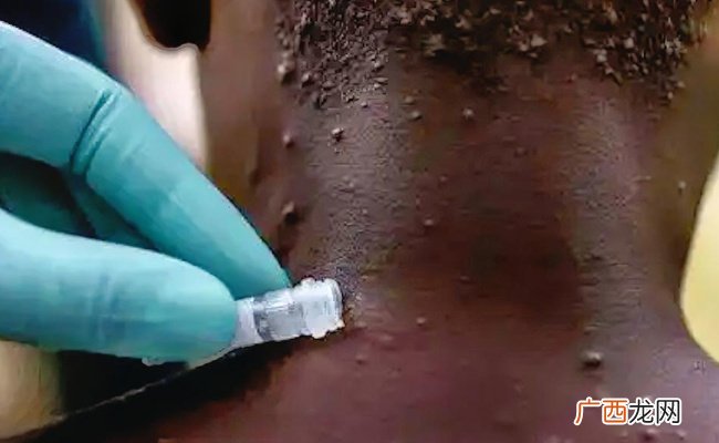 已有152例猴痘病例死亡 要如何预防猴痘呢