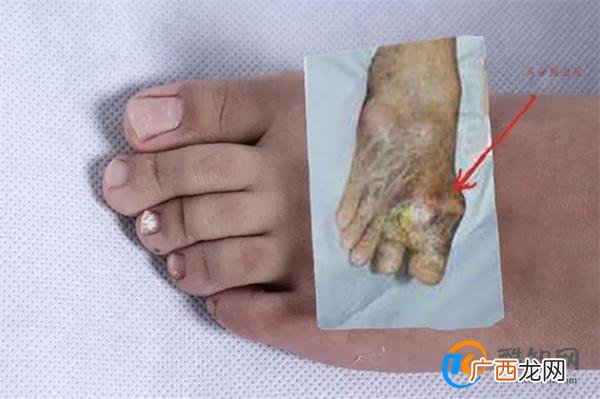 “三高”外的第四高，高尿酸怎么形成的？高尿酸血症等于痛风吗？