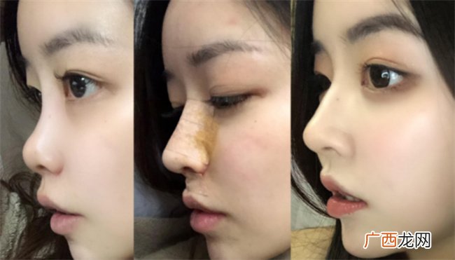 ?硅胶隆鼻有什么副作用吗硅胶隆鼻安全吗