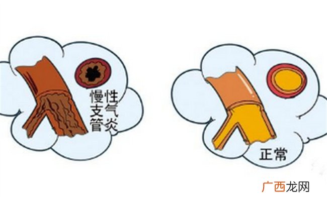 支气管炎的孩子如何保健支气管炎原因是什么