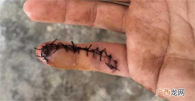 在巢湖探亲休假军人为救人手指被缝13针，徒手操作，拼命挽救