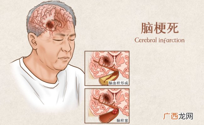 脑供血不足不宜吃什么食物脑供血不足有什么症状