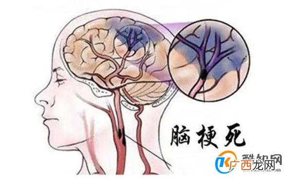 脑梗是“拖”出来的吗？睡觉时若有这3个现象，或要引起重视