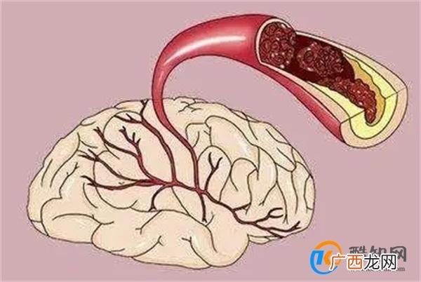 脑梗是“拖”出来的吗？睡觉时若有这3个现象，或要引起重视