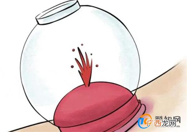 拔火罐吸出来的瘀血，是体内的毒素？揭秘其中真相，涨知识了