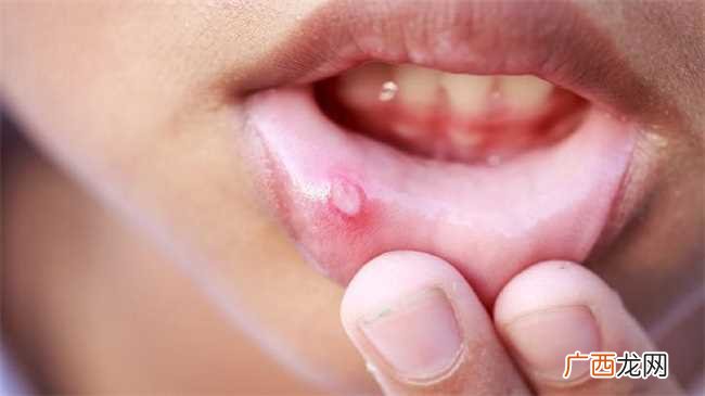 如何治疗口腔溃疡 怎么快速治疗口腔溃疡