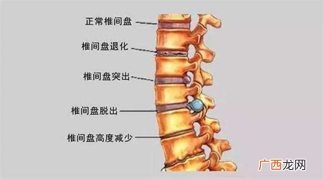 腰间盘突出症不花钱、最简单的治疗方式