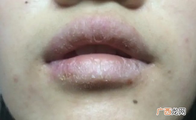 冬季嘴唇容易起皮怎么办冬季嘴唇为什么容易起皮