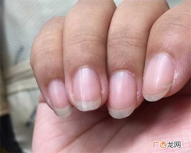 指甲表面不光滑怎么改善 如何处理指甲表面不光滑的情况