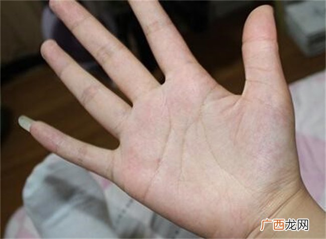 手相太阳丘凹陷是怎样的