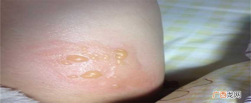 手被开水烫伤了怎么办该如何急救 被热水烫到第一时间该怎样处理