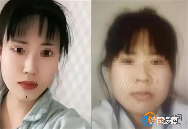 女孩花21万整形出院当天跳河自杀 整形失败如何维权
