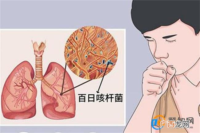 百日咳早期症状与普通感冒相似 百日咳对人体的危害